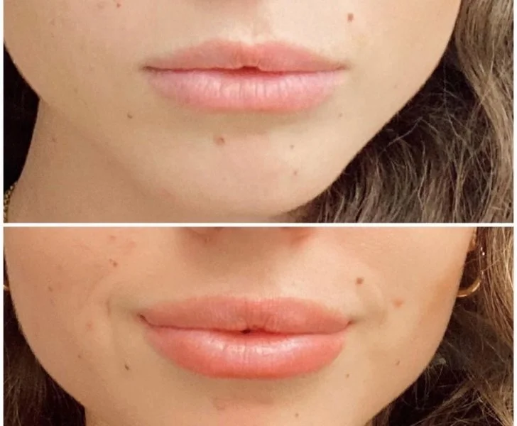 Lip Flip Before and After